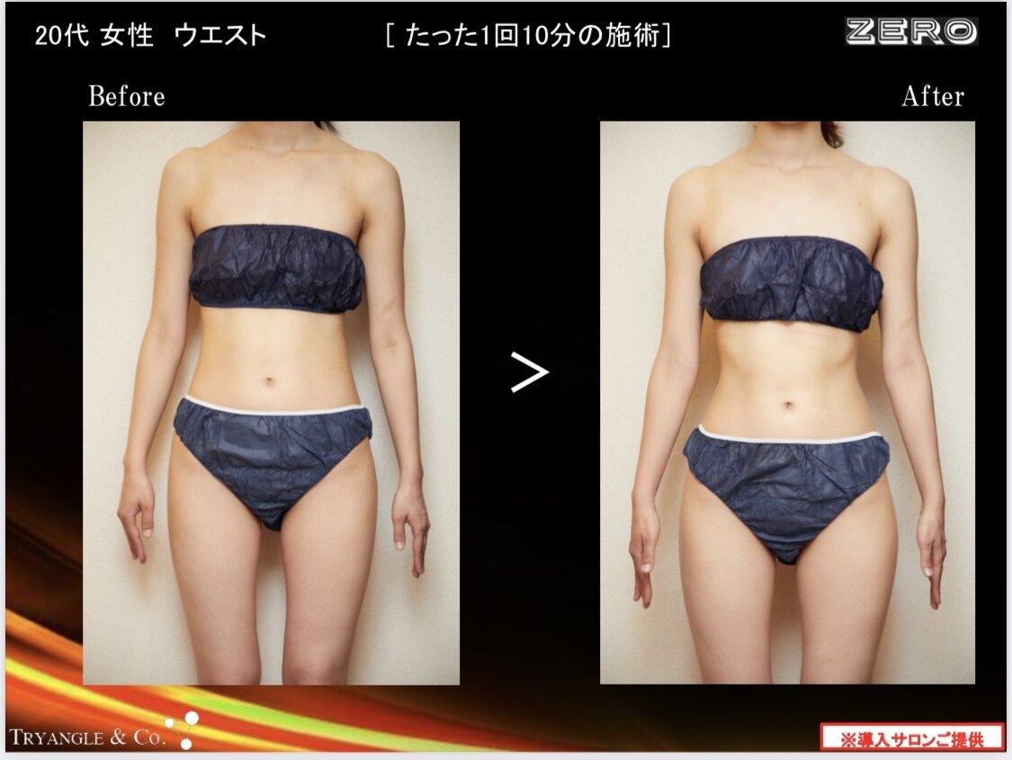 痩身キャビテーション施術のBefore/After
